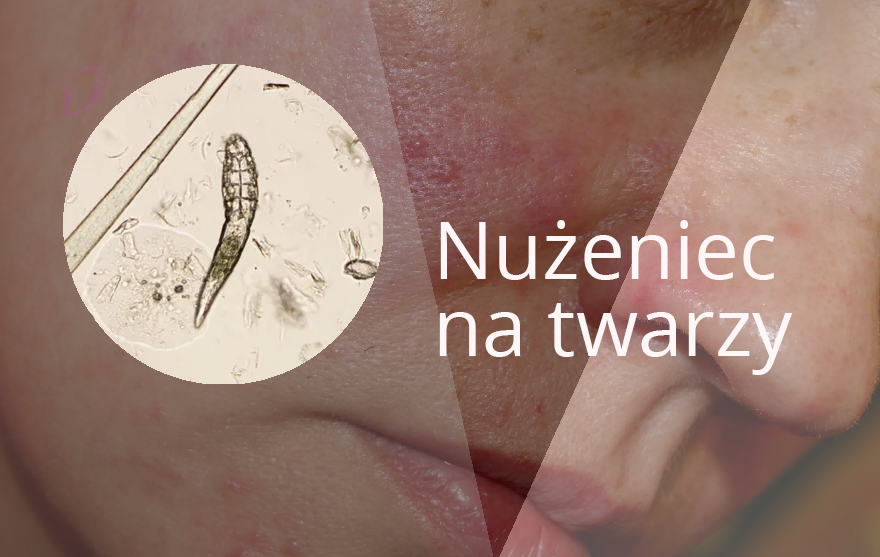 Nueniec na twarzy – sprawd, co warto wiedzie