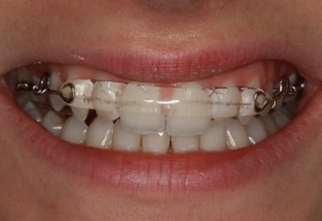 Nowoczesne leczenie ortodontyczne - jak to wygląda?