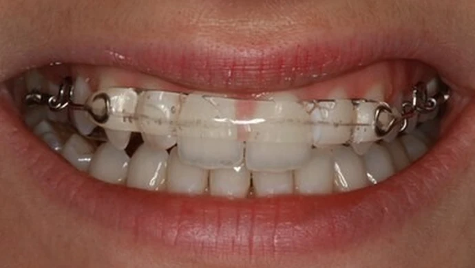 Nowoczesne leczenie ortodontyczne - jak to wygląda?