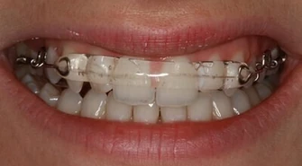 Nowoczesne leczenie ortodontyczne - jak to wygląda?