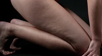 Jak skutecznie walczyć z "pomarańczową skórką"?