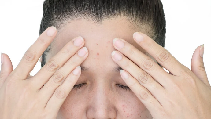 Przebarwienia skórne - czy wiesz, jak sobie z nimi radzić? 