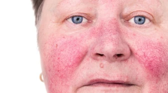 Trądzik różowaty - jak wyleczyć? Poznaj Opinie o Acnerose