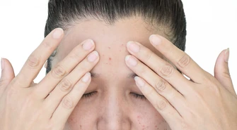 Przebarwienia skórne - czy wiesz, jak sobie z nimi radzić? 