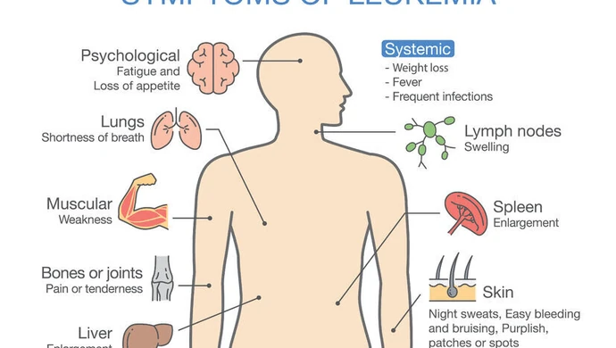 Co musisz wiedzieć o białaczce?