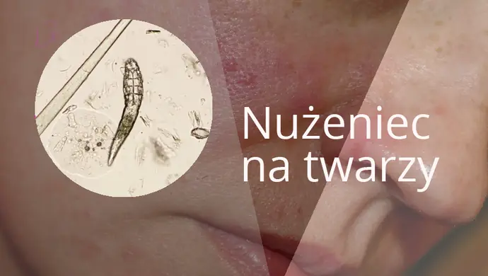 Nużeniec na twarzy – sprawdź, co warto wiedzieć