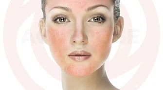 Kosmetyki na trądzik różowaty. Przedstawiamy skuteczne