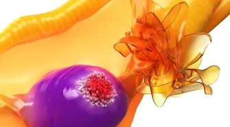 Nowe perspektywy leczenia raka jajnika