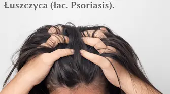 Szampon na łuszczycę - jak działa?