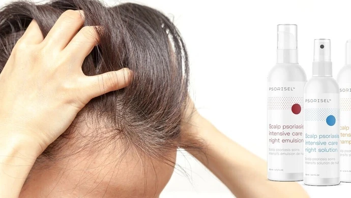 Łuszczyca głowy- na czym polega?