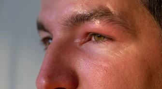 O czym może świadczyć spuchnięta powieka górna? Jakie są przyczyny opuchlizny i obrzęku powiek?