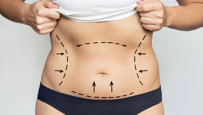 Liposukcja brzucha Łódź - jak się przygotować